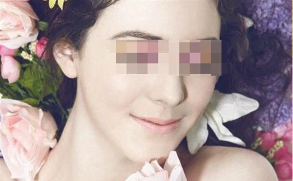 激光去除青春痘多少钱