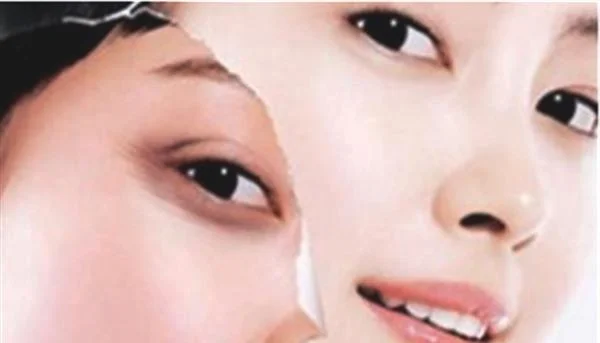 玻尿酸去鱼尾纹的效果