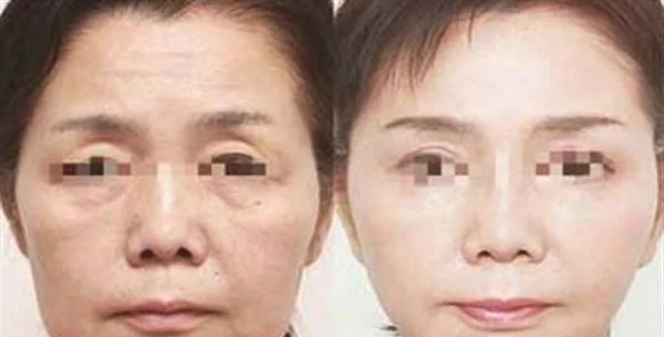 苏州埋线提升去哪家医院好？