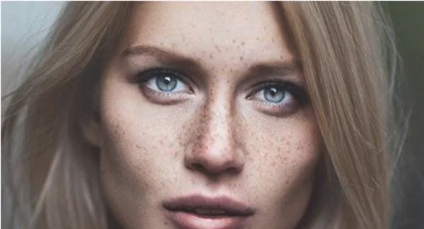 化学剥脱祛斑价格