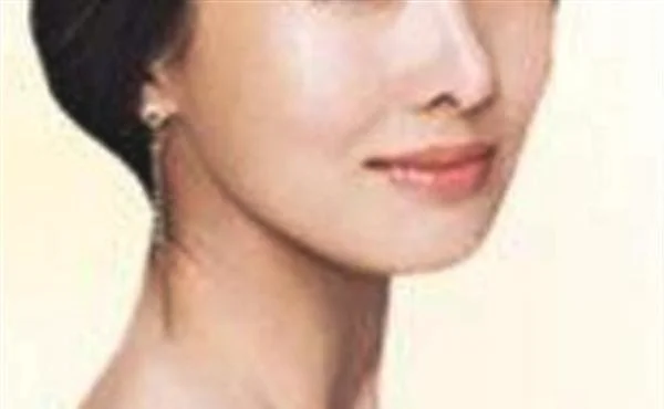 光子治疗去黄褐斑多少钱