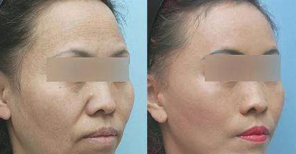 苏州整形医院哪家做埋线提升好？