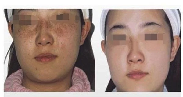 做像素激光有副作用吗