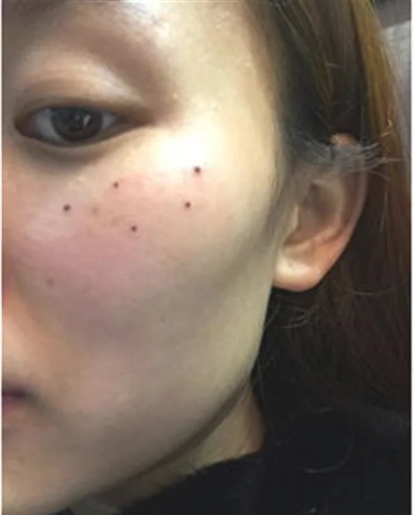 激光点痣价格