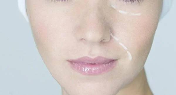 化学剥脱去斑多少钱