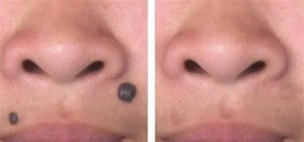 激光点痣多少钱