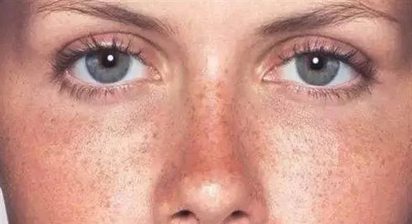 C6祛斑后可以洗脸吗