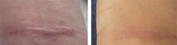 祛疤膏效果好吗