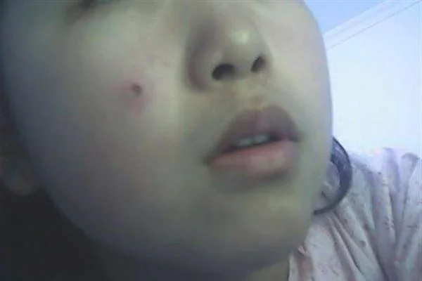 激光点痣项目要多少钱