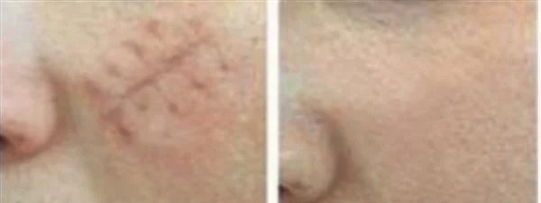 激光治疗疤痕如何做护理