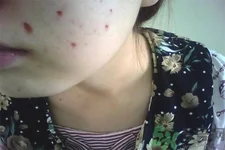 激光点痣后可以洗脸吗？激光点痣后需要注意什么？