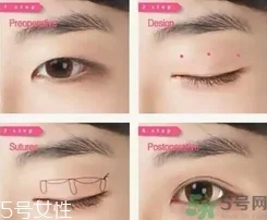 双眼皮埋线可以重做吗?双眼皮埋线可以拆吗?