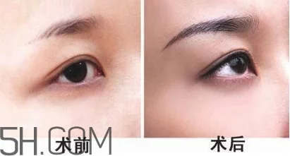 切眉手术后老得快吗？切眉能保持多久？