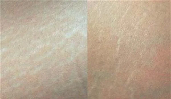 肥胖纹怎么消除效果好