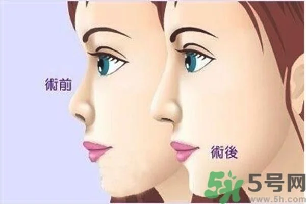 玻尿酸隆鼻的缺点是什么？玻尿酸隆鼻的优点有哪些？