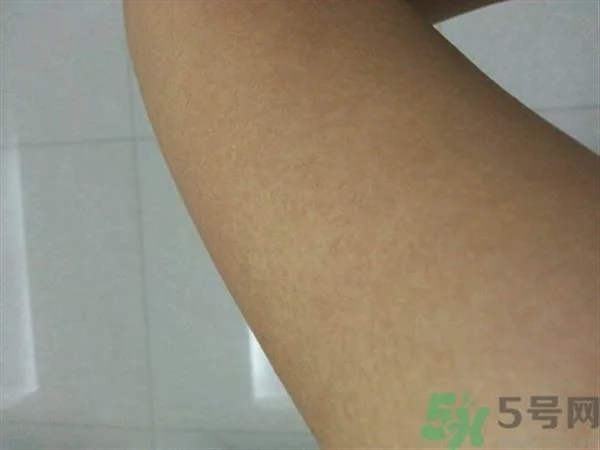 激光可以去鸡皮肤吗?激光去鸡皮肤多少钱